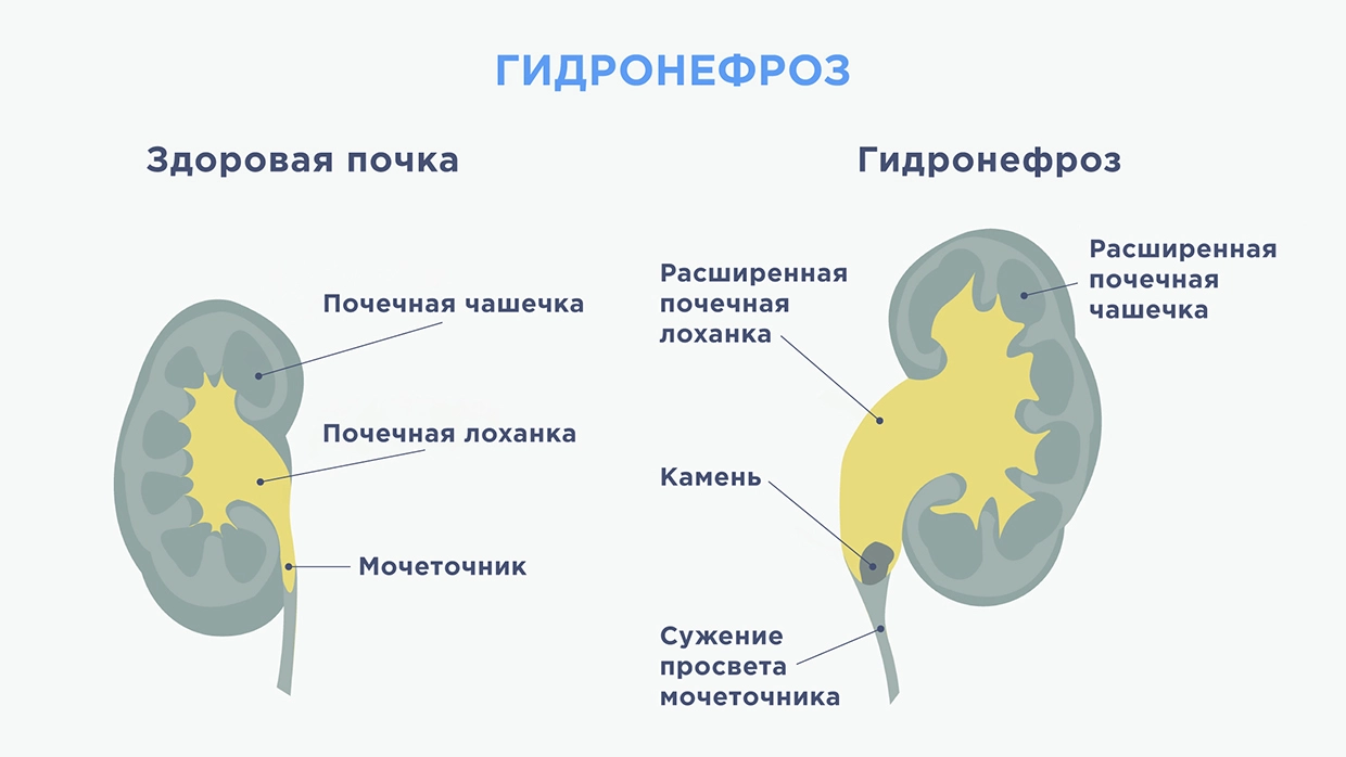 Стриктура мочеточника - причины, симптомы, диагностика и лечение